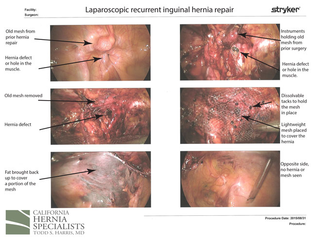 recurrent femoral hernia