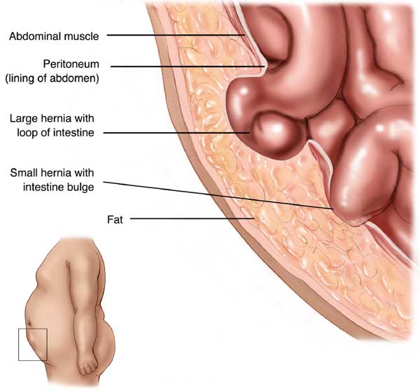 what is a hernia - Late Hernia Formation