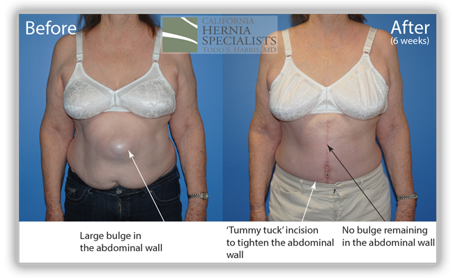 Open Incisional Hernia Repair