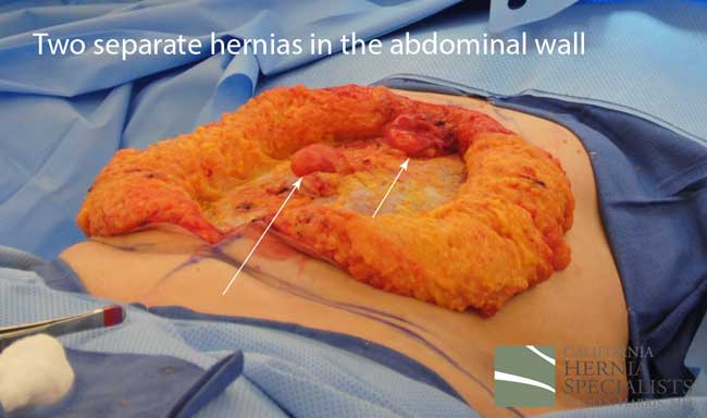 Open Incisional Hernia Repair