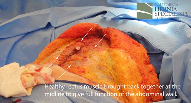 Open Incisional Hernia Repair