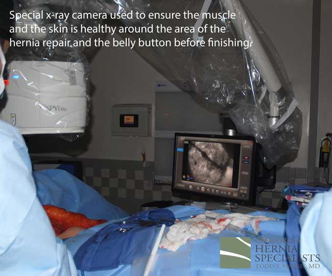 Open Incisional Hernia Repair