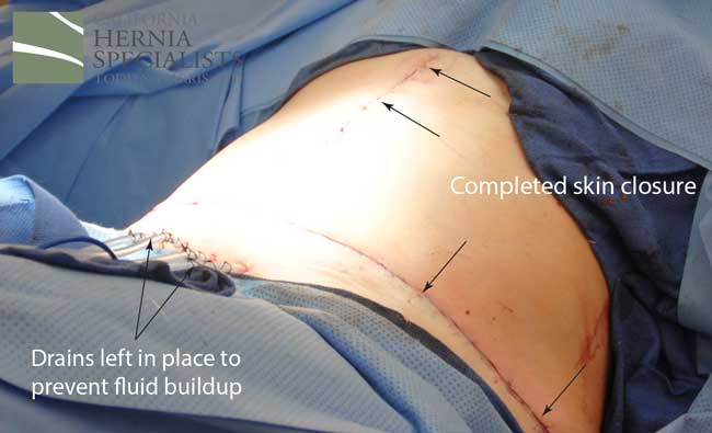 Open Incisional Hernia Repair
