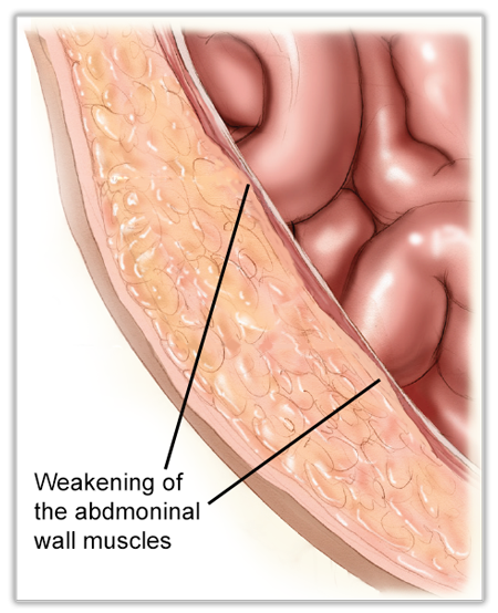 Early Abdominal Wall Hernia