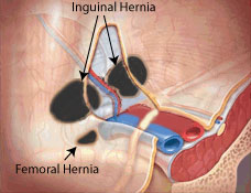 Inguinal Hernias