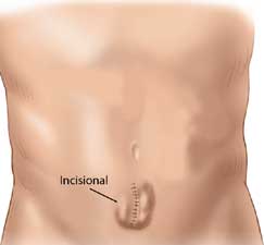 Incisional Hernia Bulges
