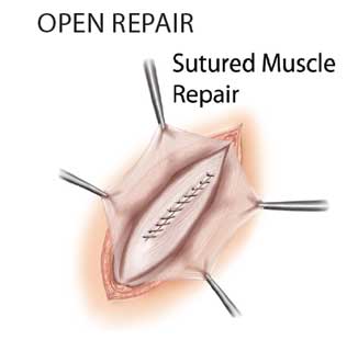 Open Primary Repair
