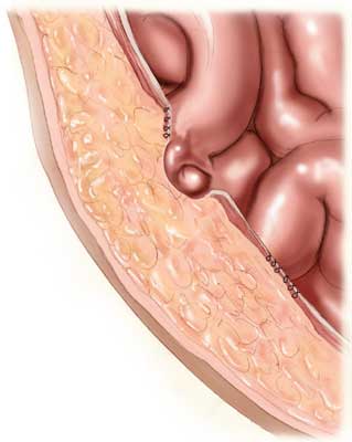 Recurrent Hernia