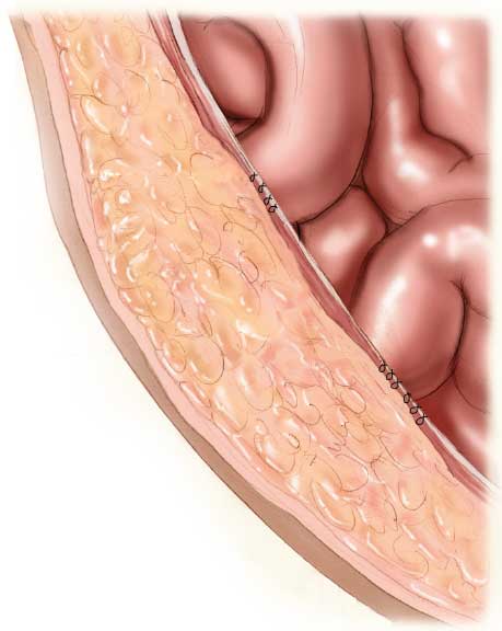 Ventral Hernia Repair No Mesh, Primary